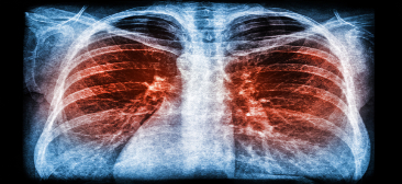 Online live CEUs for respiratory therapists:ARDS: Early Recognition and Lung Protection Part 1